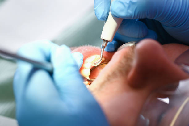Best Emergency Wisdom Tooth Extraction in Norway, MI